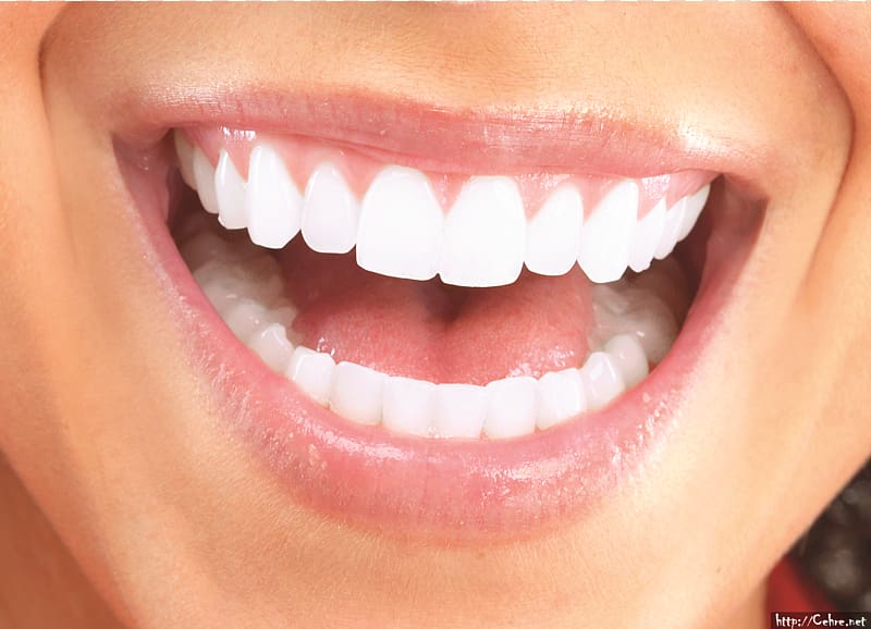 Cosmetic dentistry Veneer Dental restoration Makeover, teeth transparent background PNG clipart