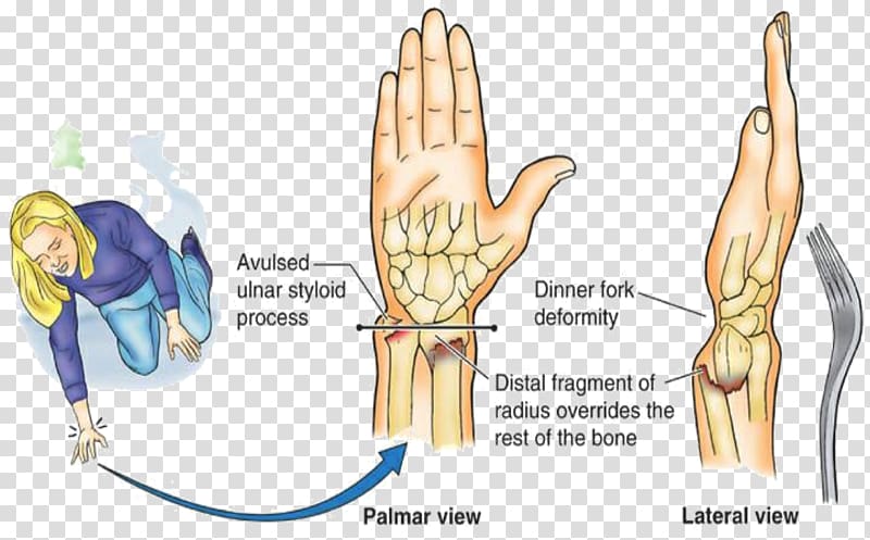 Colles' fracture Distal radius fracture Smith's fracture Physical therapy Bone fracture, others transparent background PNG clipart