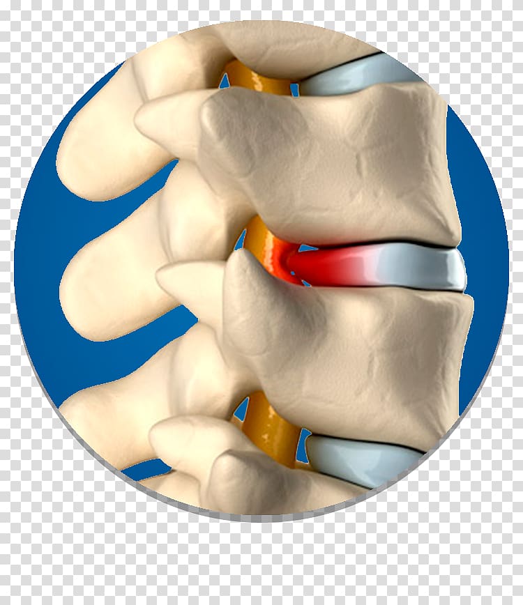 Spinal disc herniation Vertebral column Surgery Intervertebral disc, others transparent background PNG clipart