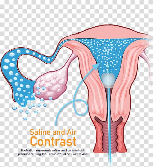 Fallopian tube Ultrasonography Infertility Uterus Hysterosalpingography, occlusion transparent background PNG clipart