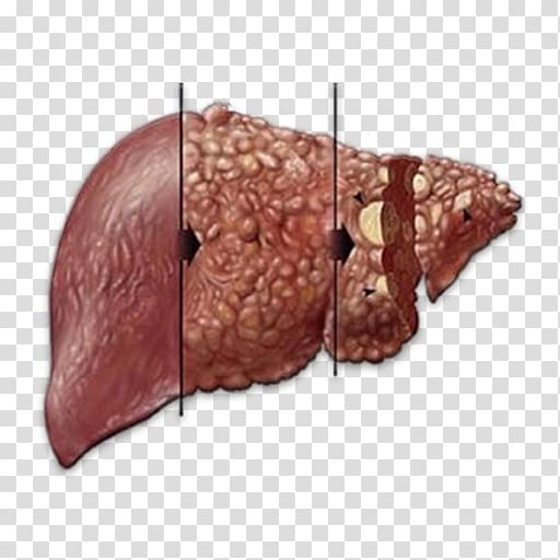 Liver disease Hepatitis C Infectious disease, others transparent background PNG clipart