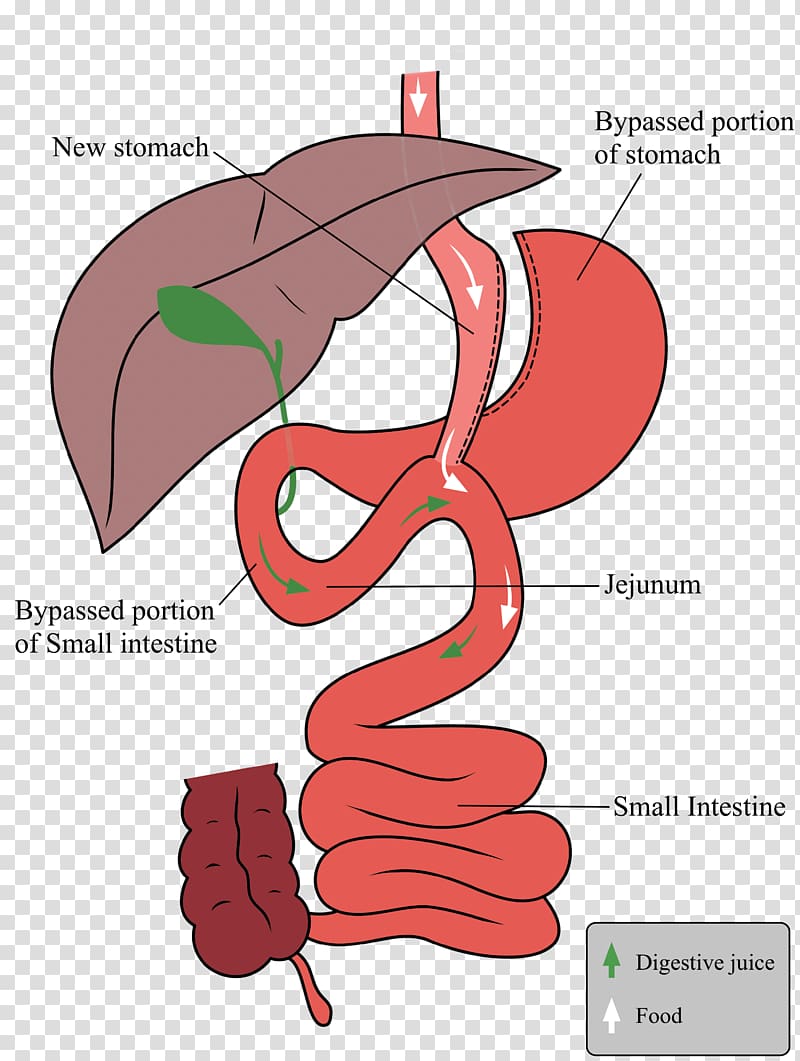 Sleeve gastrectomy Gastric bypass surgery Duodenal switch Bariatric surgery, others transparent background PNG clipart