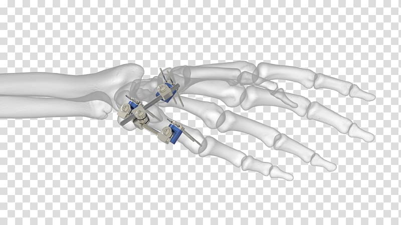 Thumb Ortho-aktiv Medizintechnik GmbH External fixation Distal radius fracture Bone, others transparent background PNG clipart