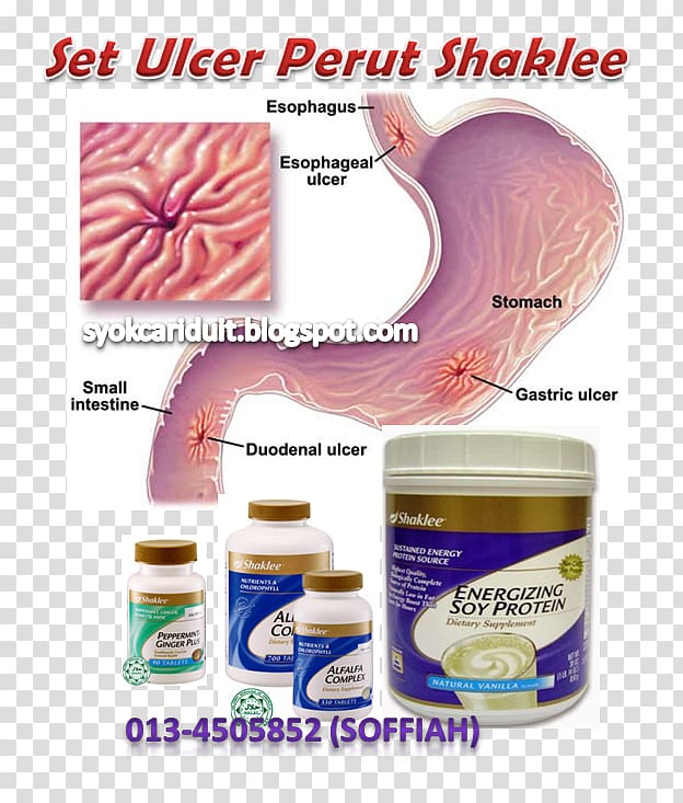 Peptic ulcer disease Stomach Gastric acid Mucous membrane Hydrochloric acid, ulcer transparent background PNG clipart