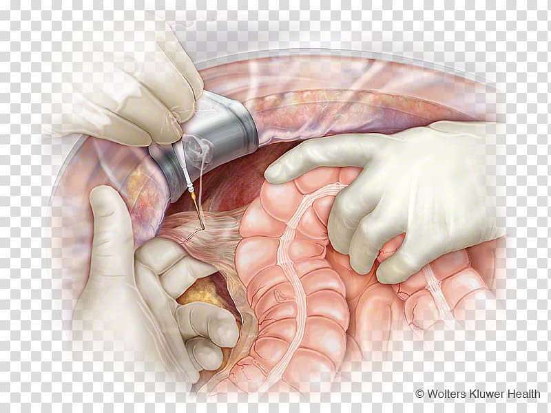 Colic flexures Ascending colon Hepatocolic ligament Colectomy Mesentery, others transparent background PNG clipart