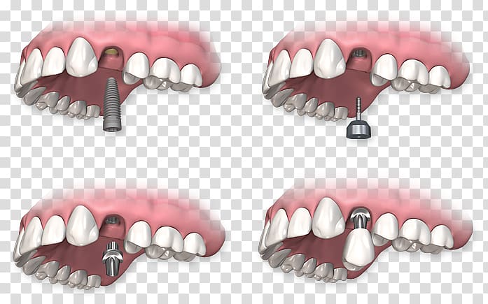 Dental implant Dentistry Dentures, crown transparent background PNG clipart