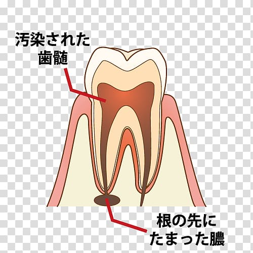 Dentist 歯科 Root canal Tooth decay Endodontic therapy, Captions transparent background PNG clipart