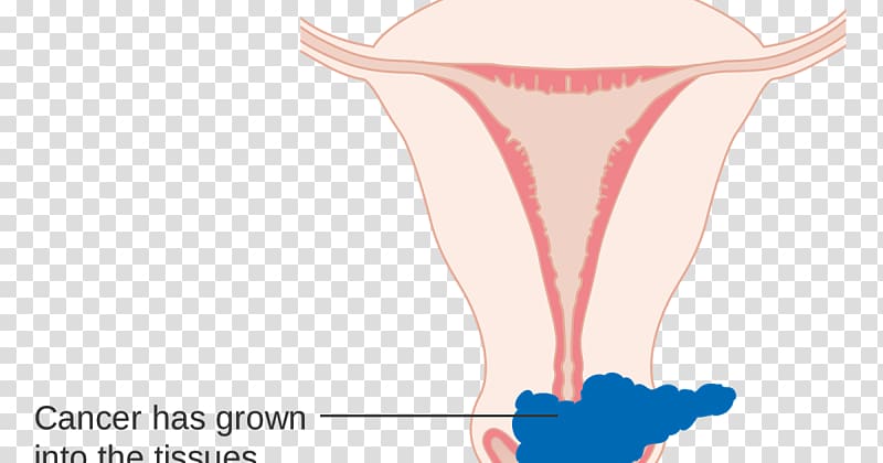 Cervical cancer staging Cervix, others transparent background PNG clipart