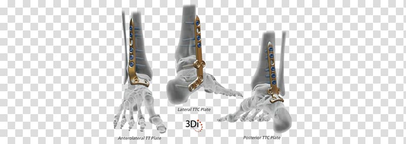 Wright Medical Group Dynamic compression plate Ankle Medicine Surgery, Medical blades transparent background PNG clipart