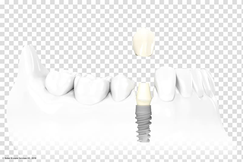 Dental implant Dentistry Dental surgery Crown, crown transparent background PNG clipart