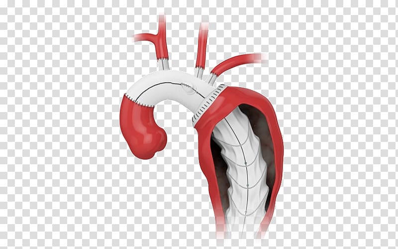 Aorta Prosthesis Endovascular aneurysm repair Stenting Surgery, others transparent background PNG clipart