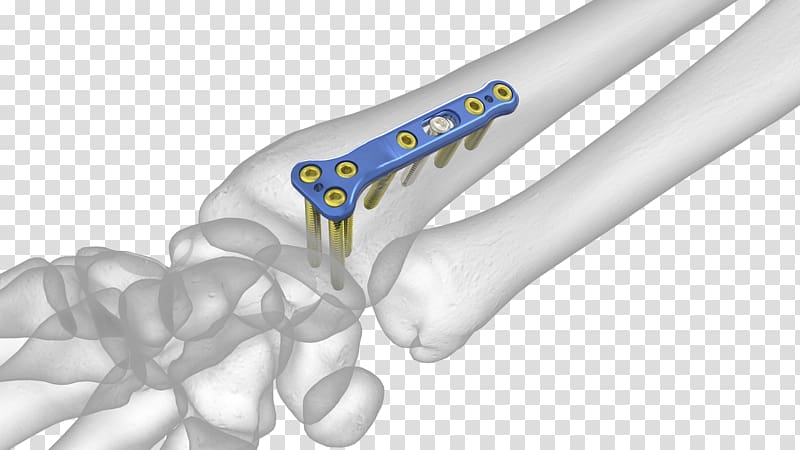 Lunate bone Distal radius fracture Radial styloid process, Bone Grafting transparent background PNG clipart