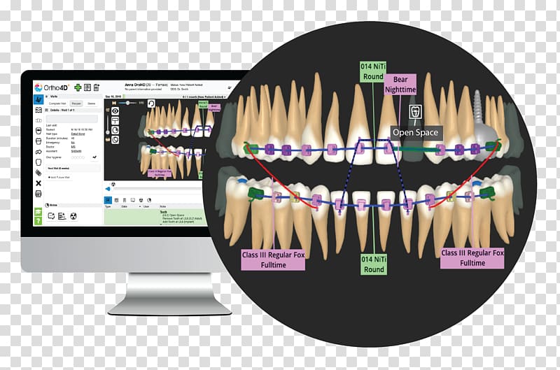 Orthodontics Human tooth Clear aligners Dentistry, 3d dental health chart transparent background PNG clipart