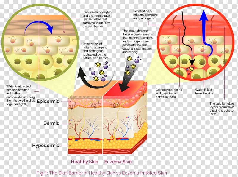 Contact dermatitis Skin Seborrheic dermatitis Cutaneous condition, cartoon pathogen transparent background PNG clipart