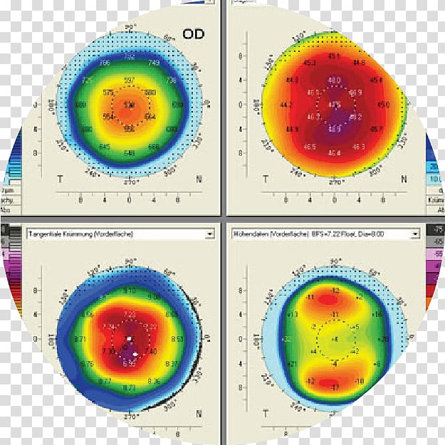 Cataract Corneal topography Eye examination, Eye transparent background PNG clipart