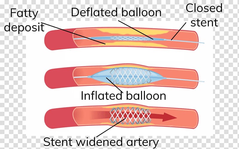 Angioplasty Heart Arteriosclerosis Artery Stenting, Coronary Artery Disease transparent background PNG clipart