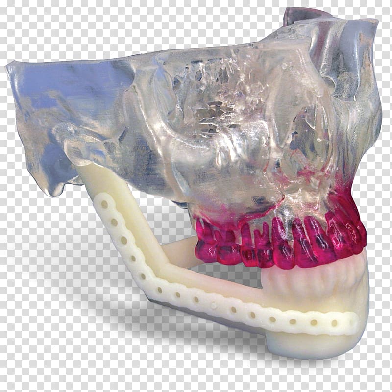 Mandible Jaw Mandibular Reconstruction Maxilla Surgery, 3d printed mandible transparent background PNG clipart