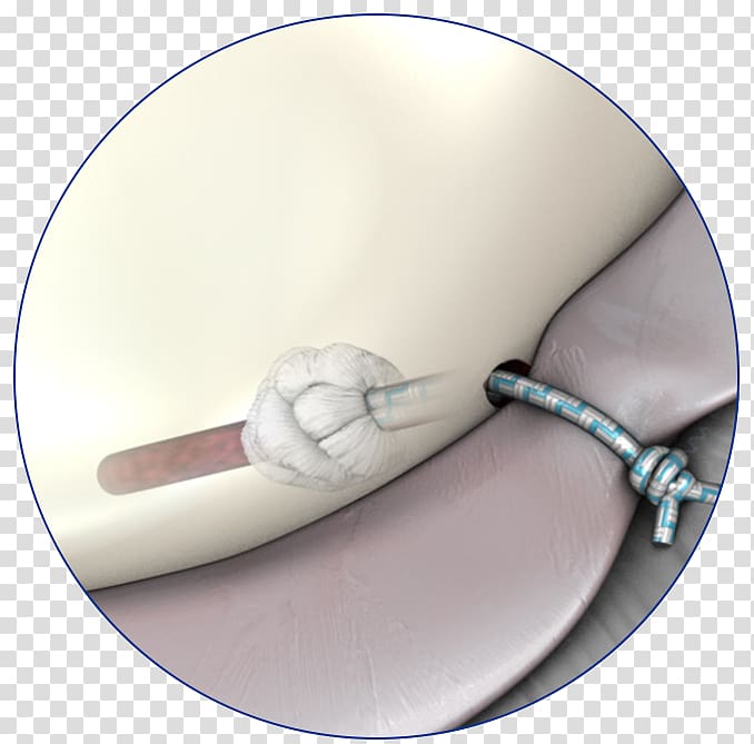 Shoulder surgery Surgical suture Medicine Glenoid labrum, suture transparent background PNG clipart