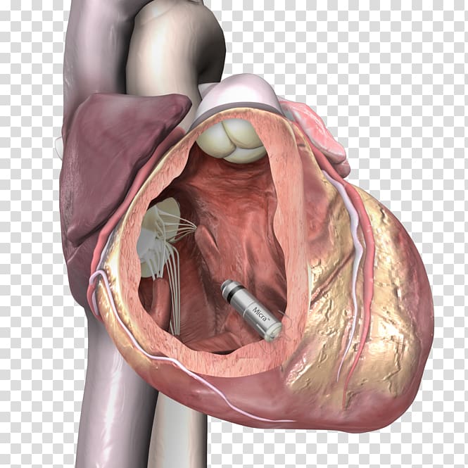 Artificial cardiac pacemaker Medtronic Implantable cardioverter-defibrillator Cardiology, heart transparent background PNG clipart