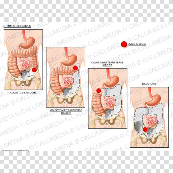 Stoma Ileostomy Ostomía Digestion Colostomy, Endocrine System transparent background PNG clipart
