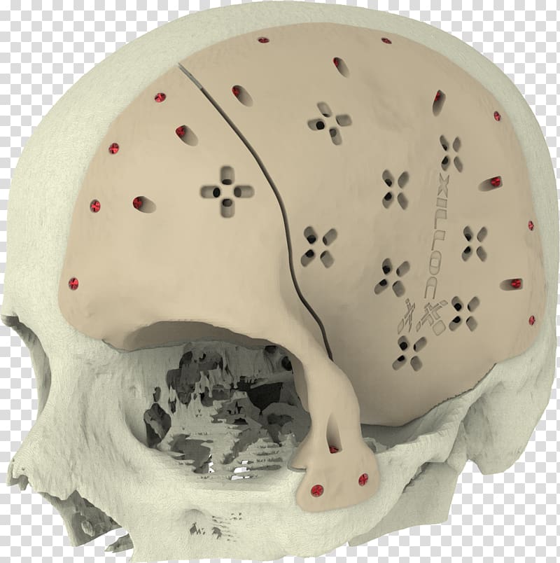 Implant Skull Surgery Knee replacement Jaw, Implants transparent background PNG clipart