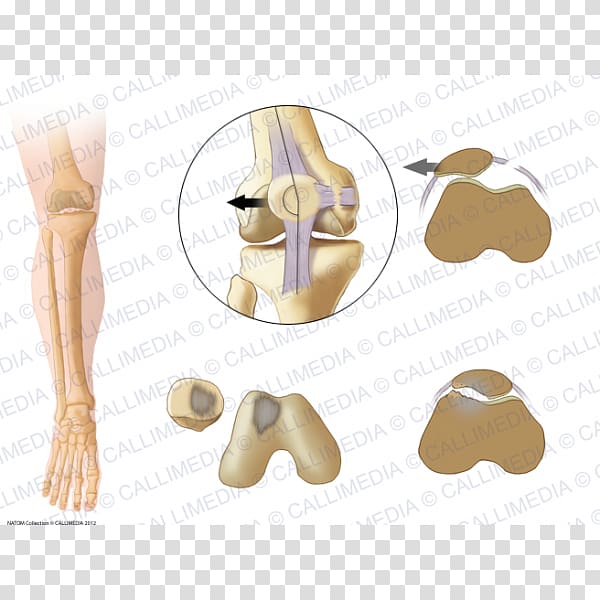 Shoulder Patella Bone Subluxation Joint dislocation, 360 Degrees transparent background PNG clipart