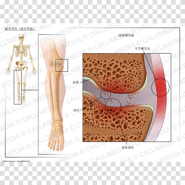 Knee arthritis Knee osteoarthritis, ráº¯n 3d transparent background PNG clipart