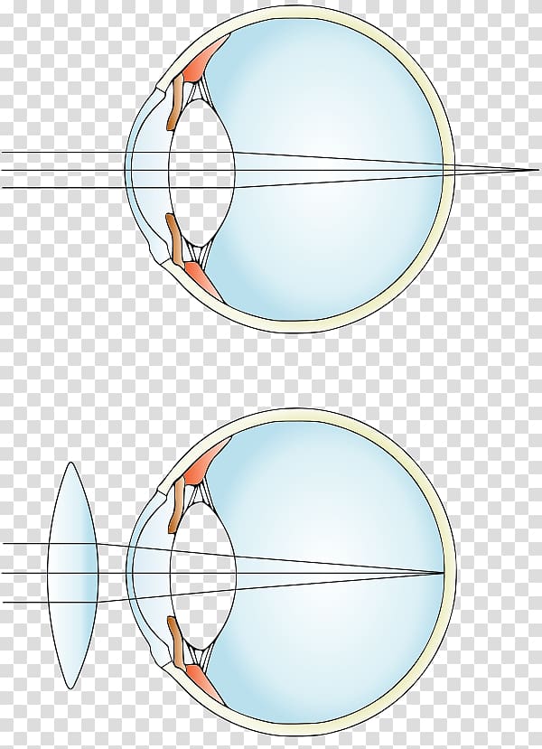 Hypermetropia Near-sightedness Lens Eye Glasses, Eye transparent background PNG clipart