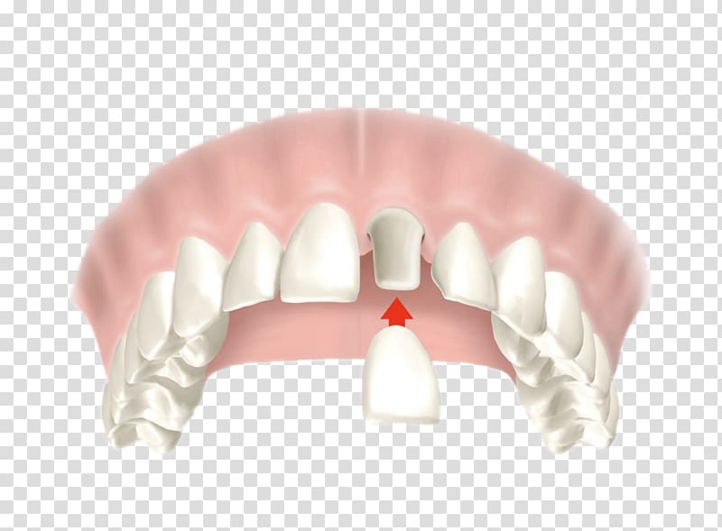 Crown Dentistry Bridge Dental restoration, dental caries transparent background PNG clipart