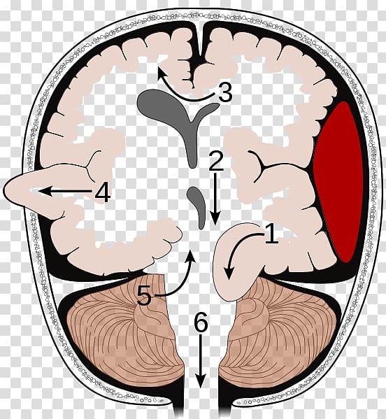 Brain herniation Intracranial pressure Traumatic brain injury Cerebellar tentorium, hole burr transparent background PNG clipart