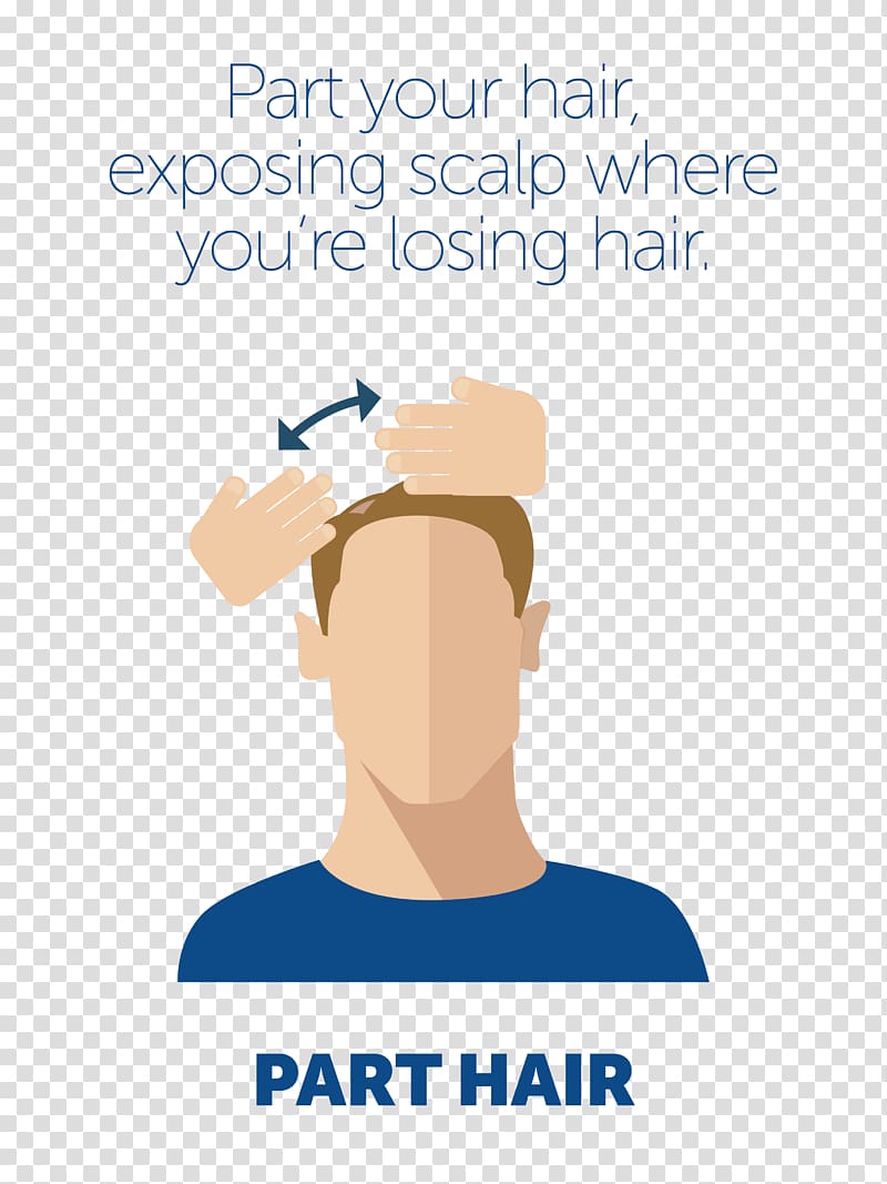 Minoxidil Scalp Management of hair loss, hair transparent background PNG clipart