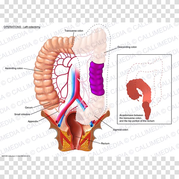 Colectomy Colorectal cancer Rectum Lymph node Surgery, others transparent background PNG clipart