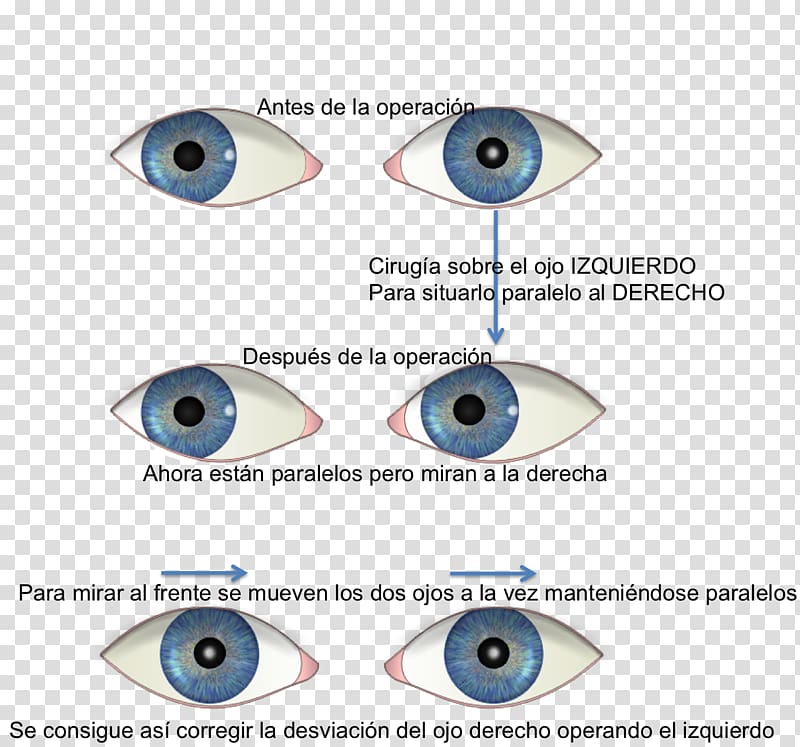 Eye Strabismus Esotropia Ophthalmology Surgery, Eye transparent background PNG clipart