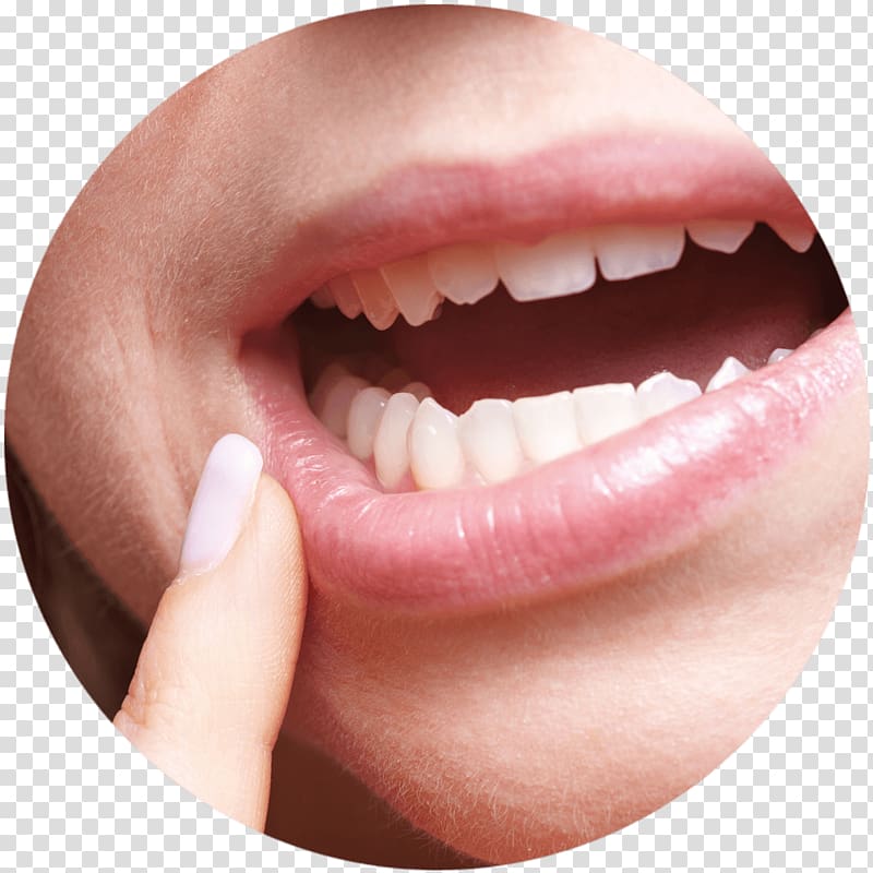 Aphthous stomatitis Dentistry Mouth ulcer Gums, chewing gum transparent background PNG clipart