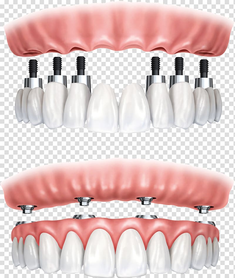 All-on-4 Dental implant Dentistry Dentures, bridge transparent background PNG clipart