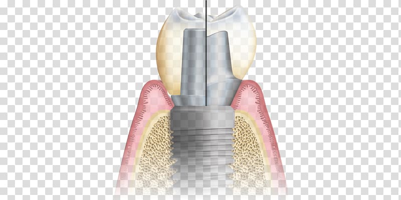 Abutment Dental implant CAD/CAM dentistry Implantology, Dental Postcard transparent background PNG clipart