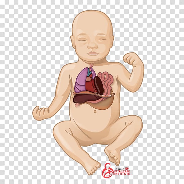 Pulmonary hypoplasia Congenital pulmonary airway malformation Congenital diaphragmatic hernia Lung, others transparent background PNG clipart