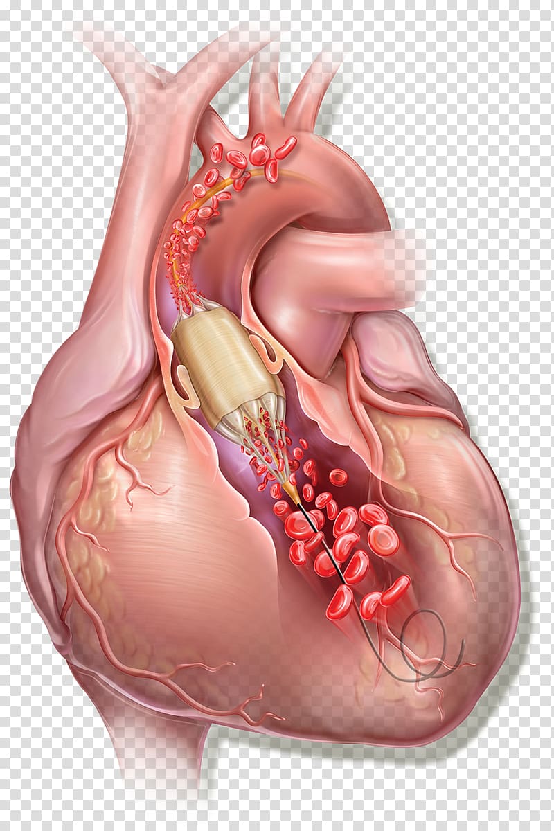Balloon catheter Balloon valvuloplasty C. R. Bard Heart, heart transparent background PNG clipart