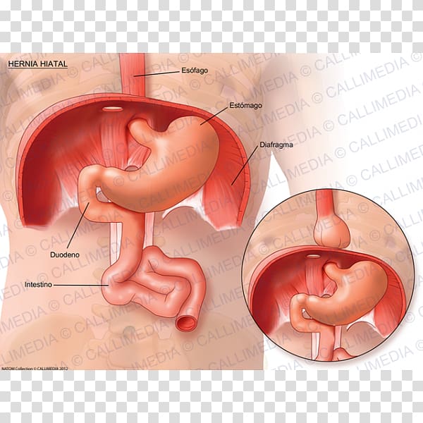 Hiatal hernia Stomach Esophagus Abdominal tenderness, others transparent background PNG clipart