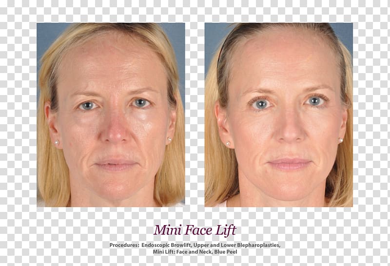 Skin Face Rhytidectomy Wrinkle Surgery, mini facelift transparent background PNG clipart