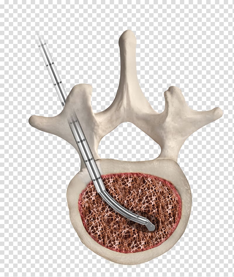 Thoracic vertebrae Human vertebral column Percutaneous vertebroplasty, others transparent background PNG clipart