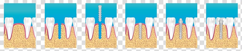 Dental implant Dentistry Surgery Bridge, Implants transparent background PNG clipart
