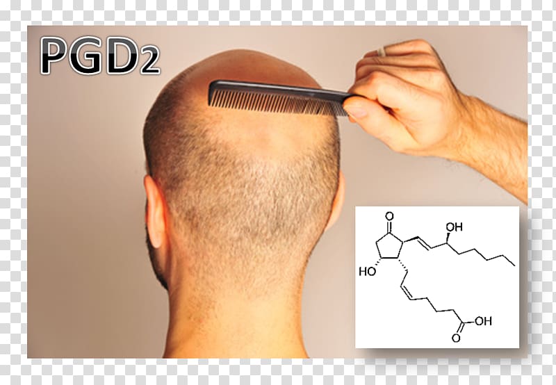 Hair loss Prostaglandin D2 Scalp, hair transparent background PNG clipart