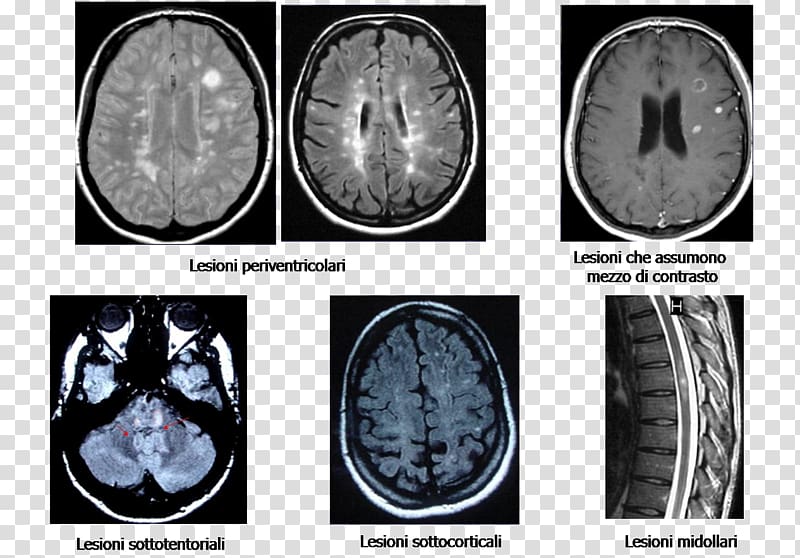 Brain Multiple sclerosis Magnetic resonance imaging Disease, Brain transparent background PNG clipart