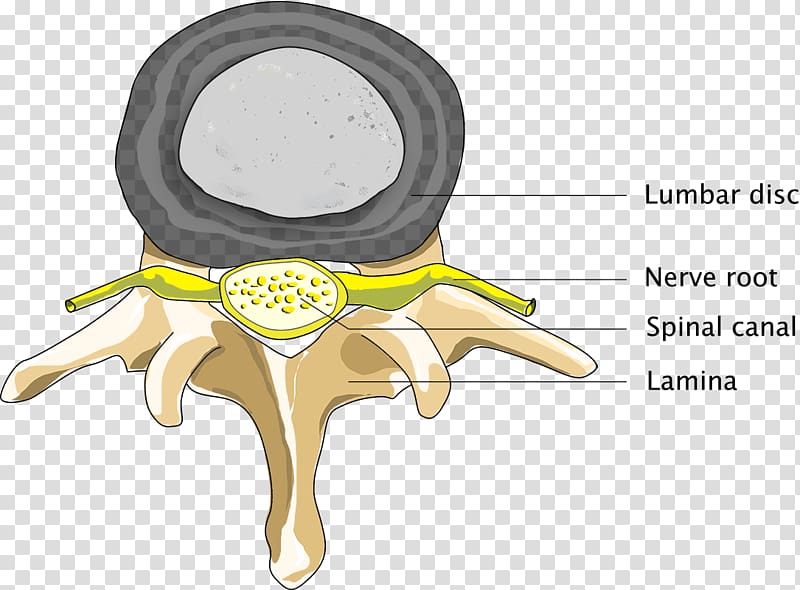 Spinal disc herniation Back pain Spinal stenosis Medical diagnosis Vertebral column, spinal back transparent background PNG clipart