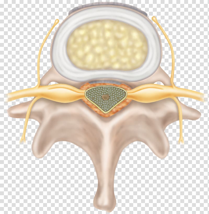 Spinal disc herniation Intervertebral disc Degenerative disc disease Cervical vertebrae Neck pain, degenerate transparent background PNG clipart