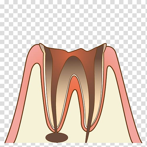 歯科 Dentist Therapy Tooth decay 診療, cavity transparent background PNG clipart