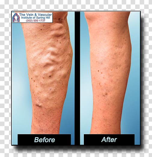 Varicose veins Vascular surgery The Vein and Vascular Institute of Tampa Bay Telangiectasia, others transparent background PNG clipart