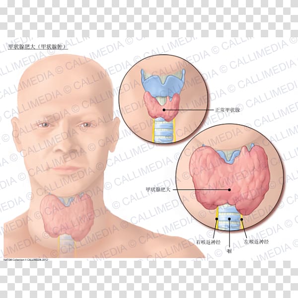 Nodule Goitre Graves\' disease Hyperthyroidism, others transparent background PNG clipart