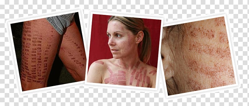 Laser hair removal Video Tattoo removal, laser peel burns transparent background PNG clipart